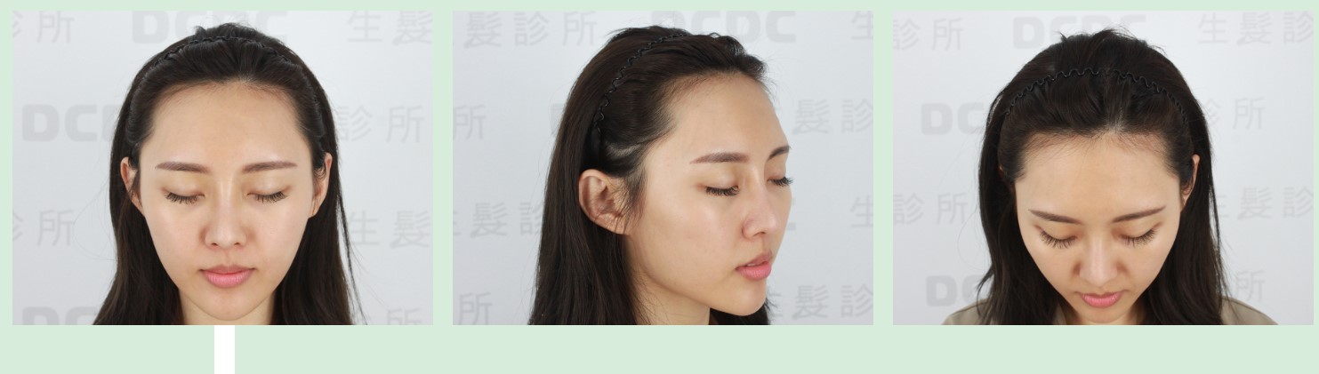 髮際線後移造成視覺較不好看